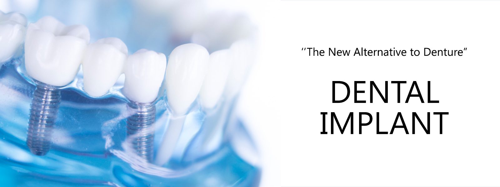 dentalimplant